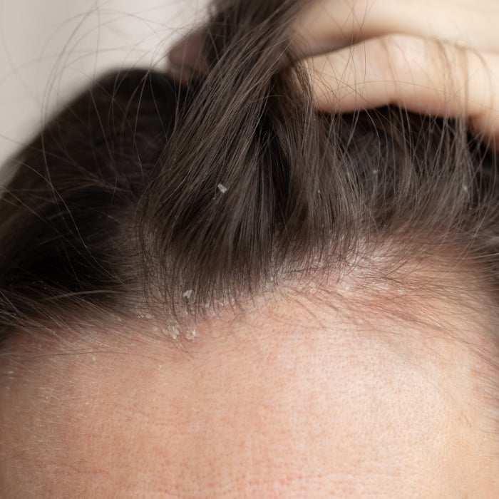 FEMME-CUIR-CHEVELU-AVEC-PELLICULES