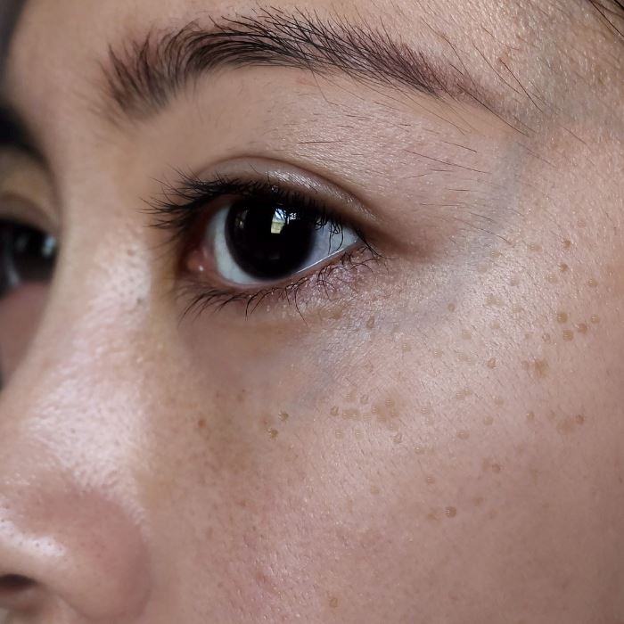 La peau hyperpigmentée : Tout savoir sur les hyperpigmentations de la peau