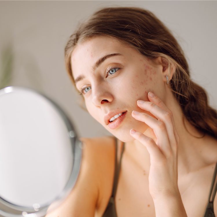 JEUNE FEMME SE REGARDANT DANS LE MIROIR AVEC DES PROBLEMES ACNEIQUES