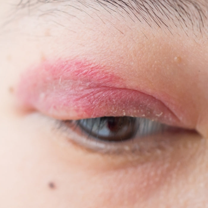 Eczéma des paupières : comprendre les causes et symptômes pour adopter le bon traitement