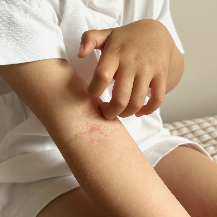 PERSONNE-QUI-GRATTE-SON-BRAS-AVEC-DE-L'ECZEMA