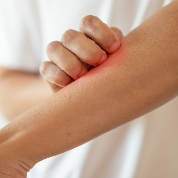 ZONES-AVEC-ECZEMA-SUR-UN-BRAS