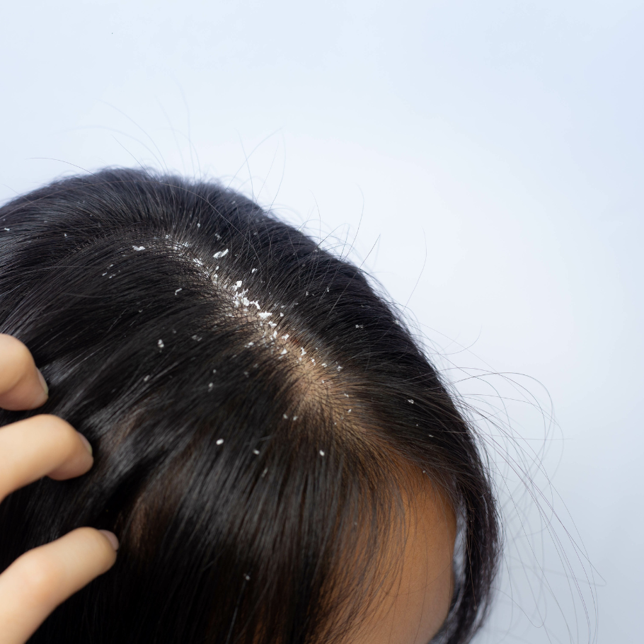 Treatment for scaly skin and dandruff conditions