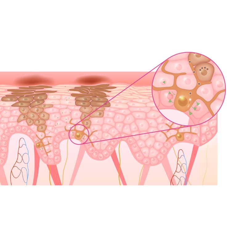 Schéma de l’hyperpigmentation de la peau